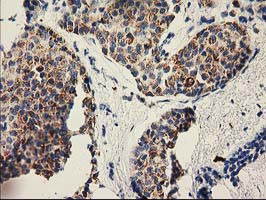 P5CR2 / PYCR2 Antibody - IHC of paraffin-embedded Adenocarcinoma of Human breast tissue using anti-PYCR2 mouse monoclonal antibody. (Heat-induced epitope retrieval by 10mM citric buffer, pH6.0, 100C for 10min).