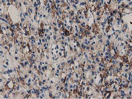 P5CR2 / PYCR2 Antibody - IHC of paraffin-embedded Carcinoma of Human kidney tissue using anti-PYCR2 mouse monoclonal antibody.