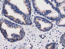 P5CR2 / PYCR2 Antibody - IHC of paraffin-embedded Carcinoma of Human prostate tissue using anti-PYCR2 mouse monoclonal antibody.