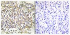 p66 / SHC Antibody - Immunohistochemistry analysis of paraffin-embedded human breast carcinoma tissue, using Shc Antibody. The picture on the right is blocked with the synthesized peptide.
