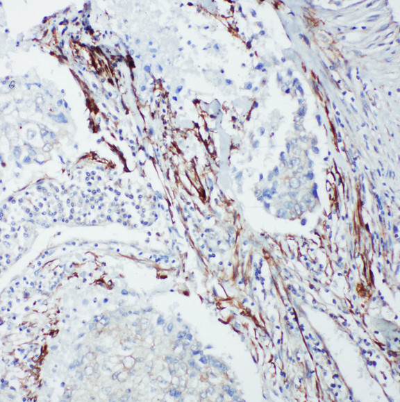 p66 / SHC Antibody - p66 / SHC antibody. IHC(P): Human Lung Cancer Tissue.