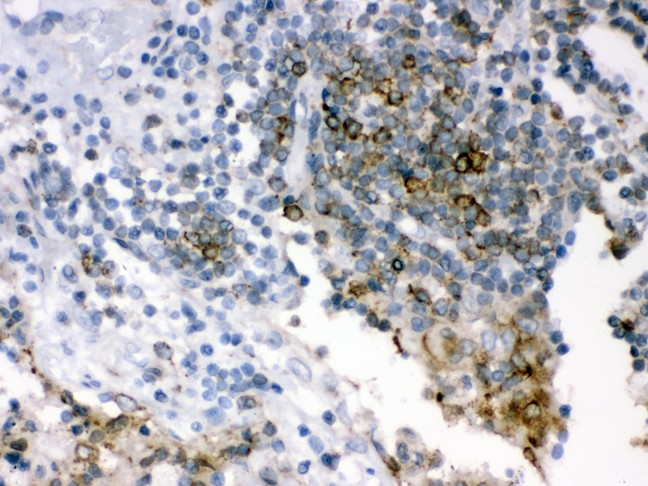 p66 / SHC Antibody - SHC1 antibody IHC-paraffin: Human Lung Cancer Tissue.