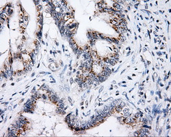 p66 / SHC Antibody - IHC of paraffin-embedded Adenocarcinoma of colon tissue using anti-SHC1 mouse monoclonal antibody. (Dilution 1:50).
