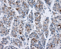 p66 / SHC Antibody - IHC of paraffin-embedded Carcinoma of liver tissue using anti-SHC1 mouse monoclonal antibody. (Dilution 1:50).