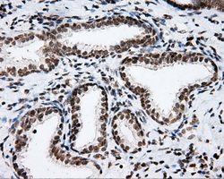 p66 / SHC Antibody - IHC of paraffin-embedded Carcinoma of prostate tissue using anti-SHC1 mouse monoclonal antibody. (Dilution 1:50).