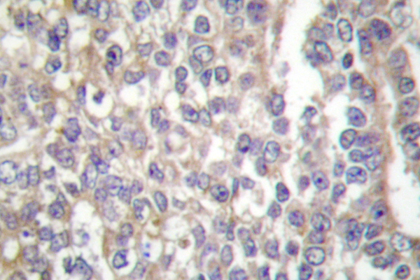 p66 / SHC Antibody - IHC of Shc (E343) pAb in paraffin-embedded human breast carcinoma tissue.