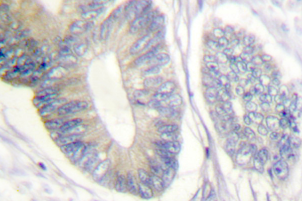 p66 / SHC Antibody - IHC of Shc (L421) pAb in paraffin-embedded human brain colon carcinoma tissue.