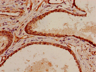 p66 / SHC Antibody - Immunohistochemistry of paraffin-embedded human prostate cancer using SHC1 Antibody at dilution of 1:100