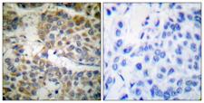 p66 / SHC Antibody - Peptide - + Immunohistochemical analysis of paraffin-embedded human breast carcinoma tissue using Shc (Ab-349) antibody.