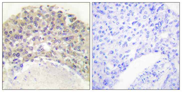 p66 / SHC Antibody - Immunohistochemistry analysis of paraffin-embedded human breast carcinoma, using Shc (Phospho-Tyr349) Antibody. The picture on the right is blocked with the phospho peptide.