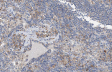 p66 / SHC Antibody - 1:100 staining human lymphoma tissue by IHC-P. The tissue was formaldehyde fixed and a heat mediated antigen retrieval step in citrate buffer was performed. The tissue was then blocked and incubated with the antibody for 1.5 hours at 22°C. An HRP conjugated goat anti-rabbit antibody was used as the secondary.
