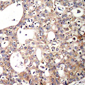 p66 / SHC Antibody - Immunohistochemical analysis of paraffin-embedded human breast carcinoma tissue.