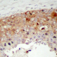 p66 / SHC Antibody - Immunohistochemical analysis of SHCA (pY427) staining in human prostate cancer formalin fixed paraffin embedded tissue section. The section was pre-treated using heat mediated antigen retrieval with sodium citrate buffer (pH 6.0). The section was then incubated with the antibody at room temperature and detected using an HRP polymer system. DAB was used as the chromogen. The section was then counterstained with hematoxylin and mounted with DPX.