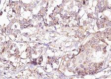 p66 / SHC Antibody - 1:100 staining human breast carcinoma tissue by IHC-P. The tissue was formaldehyde fixed and a heat mediated antigen retrieval step in citrate buffer was performed. The tissue was then blocked and incubated with the antibody for 1.5 hours at 22°C. An HRP conjugated goat anti-rabbit antibody was used as the secondary.