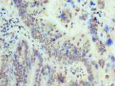 p84 / THOC1 Antibody - Immunohistochemistry of paraffin-embedded human colon cancer using antibody at 1:100 dilution.
