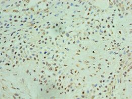 p84 / THOC1 Antibody - Immunohistochemistry of paraffin-embedded human breast cancer using antibody at 1:100 dilution.