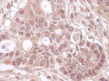 p84 / THOC1 Antibody - Detection of Human THOC1 by Immunohistochemistry. Sample: FFPE section of human ovarian carcinoma. Antibody: Affinity purified rabbit anti-THOC1 used at a dilution of 1:1000 (1 ug/ml). Detection: Vector Laboratories ImmPACT NovaRED Peroxidase Substrate.