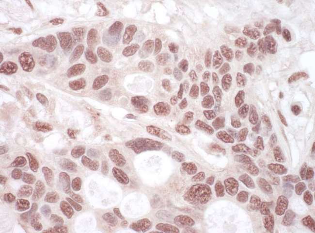 p84 / THOC1 Antibody - Detection of Human THOC1 by Immunohistochemistry. Sample: FFPE section of human ovarian carcinoma. Antibody: Affinity purified rabbit anti-THOC1 used at a dilution of 1:200 (1 ug/ml). Detection: Vector Laboratories ImmPACT NovaRED Peroxidase Substrate.