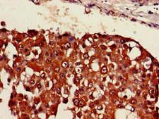 PA26 / SESN1 Antibody - Immunohistochemistry of paraffin-embedded human breast cancer at dilution of 1:100