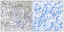 PA26 / SESN1 Antibody - Immunohistochemistry analysis of paraffin-embedded human breast carcinoma tissue, using SESN1 Antibody. The picture on the right is blocked with the synthesized peptide.