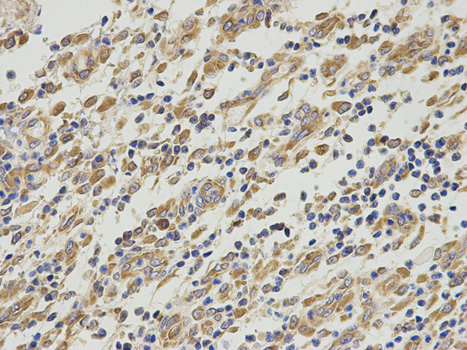 PA2G4 / EBP1 Antibody - Immunohistochemistry of paraffin-embedded human stomach cancer using PA2G4 antibody at dilution of 1:200 (400x lens).
