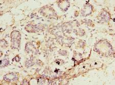 PA2G4 / EBP1 Antibody - Immunohistochemistry of paraffin-embedded human breast cancer using antibody at dilution of 1:100.