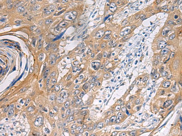 PA2G4 / EBP1 Antibody - Immunohistochemistry of paraffin-embedded Human esophagus cancer tissue  using PA2G4 Polyclonal Antibody at dilution of 1:60(×200)