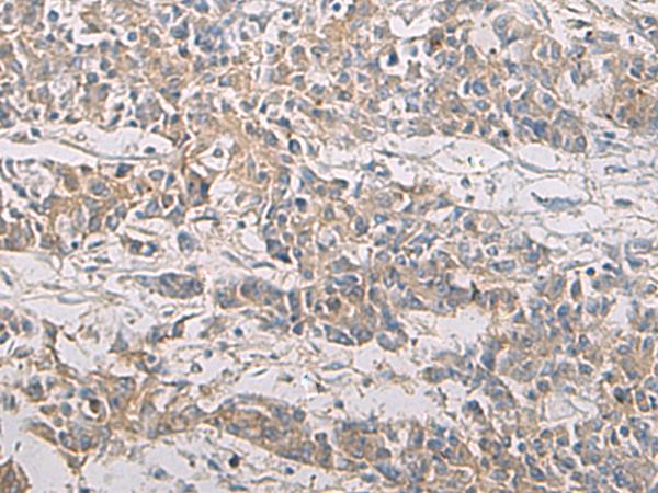 PA2G4 / EBP1 Antibody - Immunohistochemistry of paraffin-embedded Human colorectal cancer tissue  using PA2G4 Polyclonal Antibody at dilution of 1:60(×200)