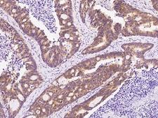 PABPC1 / PABP1 Antibody - Immunochemical staining of human PABPC1 in human colon carcinoma with rabbit polyclonal antibody at 1:2500 dilution, formalin-fixed paraffin embedded sections.