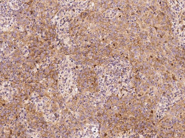 PABPC1 / PABP1 Antibody - Immunochemical staining of human PABPC1 in human lung cancer with rabbit polyclonal antibody at 1:2500 dilution, formalin-fixed paraffin embedded sections.
