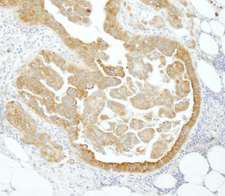 PABPC4 Antibody - Detection of Human PABP4 by Immunohistochemistry. Sample: FFPE section of human ovarian carcinoma. Antibody: Affinity purified rabbit anti-PABP4 used at a dilution of 1:250.