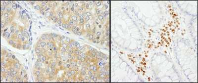 PABPC4 Antibody - Detection of Human PABP4 by Immunohistochemistry. Sample: FFPE section of human prostate carcinoma (left) and colon carcinoma (right). Antibody: Affinity purified rabbit anti-PABP4 used at a dilution of 1:200 (1 ug/ml). Detection: DAB.