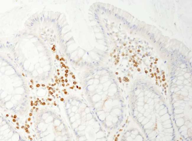 PABPC4 Antibody - Detection of Human PABP4 by Immunohistochemistry. Sample: FFPE section of human colon carcinoma. Antibody: Affinity purified rabbit anti-PABP4 used at a dilution of 1:200 (1 ug/ml). Detection: DAB.