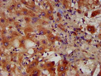 PACS2 Antibody - Immunohistochemistry image at a dilution of 1:400 and staining in paraffin-embedded human liver tissue performed on a Leica BondTM system. After dewaxing and hydration, antigen retrieval was mediated by high pressure in a citrate buffer (pH 6.0) . Section was blocked with 10% normal goat serum 30min at RT. Then primary antibody (1% BSA) was incubated at 4 °C overnight. The primary is detected by a biotinylated secondary antibody and visualized using an HRP conjugated SP system.