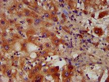 PACS2 Antibody - Immunohistochemistry image at a dilution of 1:400 and staining in paraffin-embedded human liver tissue performed on a Leica BondTM system. After dewaxing and hydration, antigen retrieval was mediated by high pressure in a citrate buffer (pH 6.0) . Section was blocked with 10% normal goat serum 30min at RT. Then primary antibody (1% BSA) was incubated at 4 °C overnight. The primary is detected by a biotinylated secondary antibody and visualized using an HRP conjugated SP system.