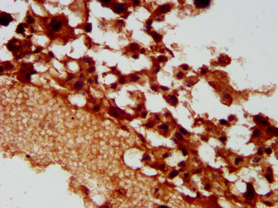 PACS2 Antibody - Immunohistochemistry image at a dilution of 1:400 and staining in paraffin-embedded human melanoma cancer performed on a Leica BondTM system. After dewaxing and hydration, antigen retrieval was mediated by high pressure in a citrate buffer (pH 6.0) . Section was blocked with 10% normal goat serum 30min at RT. Then primary antibody (1% BSA) was incubated at 4 °C overnight. The primary is detected by a biotinylated secondary antibody and visualized using an HRP conjugated SP system.