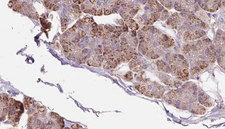 PACS2 Antibody - 1:100 staining human pancreas carcinoma tissue by IHC-P. The sample was formaldehyde fixed and a heat mediated antigen retrieval step in citrate buffer was performed. The sample was then blocked and incubated with the antibody for 1.5 hours at 22°C. An HRP conjugated goat anti-rabbit antibody was used as the secondary.