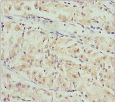 PACSIN2 Antibody - Immunohistochemistry of paraffin-embedded human gastric cancer at dilution 1:100