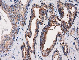 PACSIN3 Antibody - IHC of paraffin-embedded Carcinoma of Human prostate tissue using anti-PACSIN3 mouse monoclonal antibody.