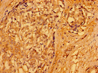PACSIN3 Antibody - Immunohistochemistry image of paraffin-embedded human breast cancer at a dilution of 1:100