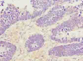 PADI3 Antibody - Immunohistochemistry of paraffin-embedded human ovarian cancer using antibody at dilution of 1:100.