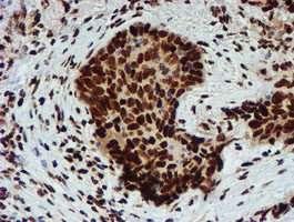 PADI4 / PAD4 Antibody - IHC of paraffin-embedded Carcinoma of Human lung tissue using anti-PADI4 mouse monoclonal antibody.