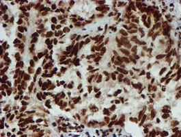 PADI4 / PAD4 Antibody - IHC of paraffin-embedded Adenocarcinoma of Human ovary tissue using anti-PADI4 mouse monoclonal antibody.
