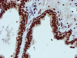 PADI4 / PAD4 Antibody - IHC of paraffin-embedded Carcinoma of Human prostate tissue using anti-PADI4 mouse monoclonal antibody.