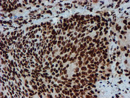 PADI4 / PAD4 Antibody - IHC of paraffin-embedded Carcinoma of Human bladder tissue using anti-PADI4 mouse monoclonal antibody.