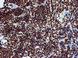 PADI4 / PAD4 Antibody - IHC of paraffin-embedded Human lymphoma tissue using anti-PADI4 mouse monoclonal antibody.