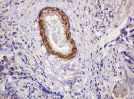 PADI4 / PAD4 Antibody - IHC of paraffin-embedded Adenocarcinoma of Human breast tissue using anti-PADI4 mouse monoclonal antibody.
