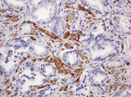 PADI4 / PAD4 Antibody - IHC of paraffin-embedded Carcinoma of Human prostate tissue using anti-PADI4 mouse monoclonal antibody.