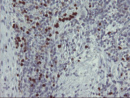PADI4 / PAD4 Antibody - IHC of paraffin-embedded Carcinoma of Human bladder tissue using anti-PADI4 mouse monoclonal antibody.