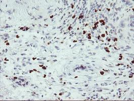 PADI4 / PAD4 Antibody - IHC of paraffin-embedded Carcinoma of Human lung tissue using anti-PADI4 mouse monoclonal antibody.